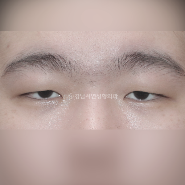 남자 무쌍눈매교정 BEFORE