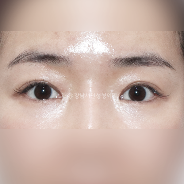 앞트임 복원 + 쌍꺼풀 라인낮추기 AFTER