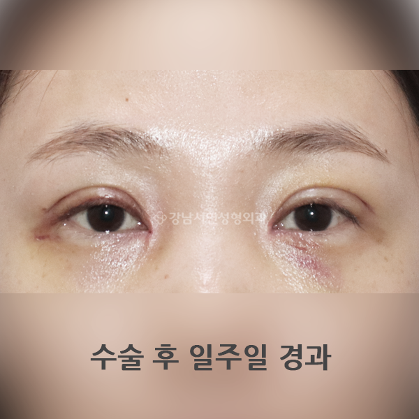 쌍꺼풀 재수술+앞트임 일주일 경과 부기 정도 AFTER