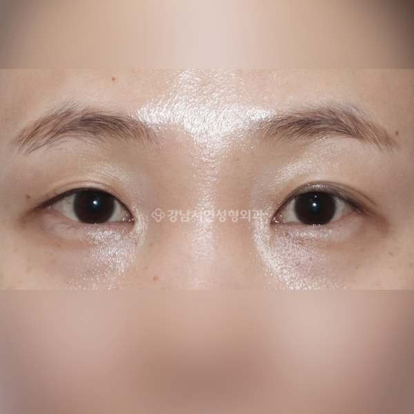 쌍꺼풀 재수술+앞트임 일주일 경과 부기 정도 BEFORE