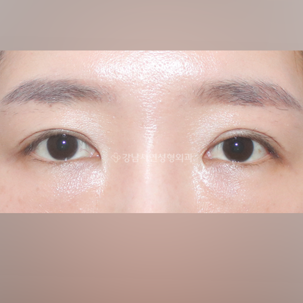 두줄따기 라인 낮추기 AFTER