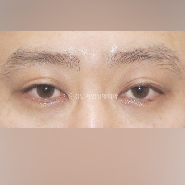 절개눈매교정 + 남자 쌍꺼풀 감추기 BEFORE