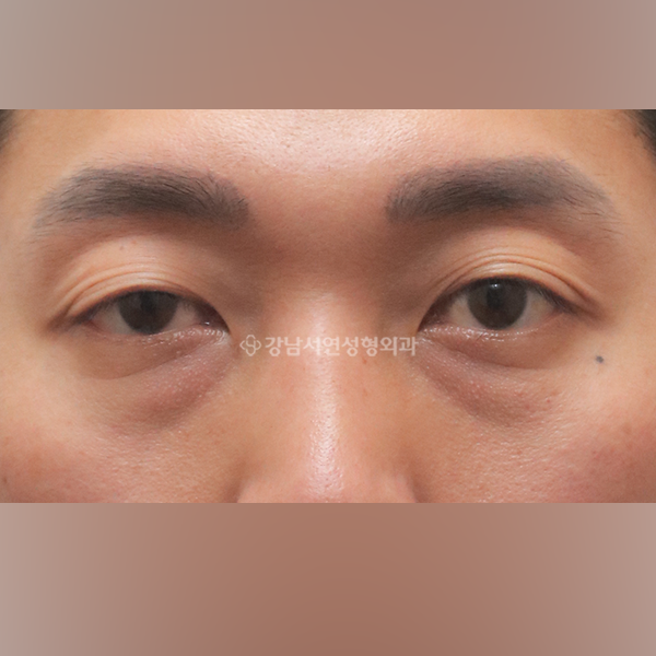 비대칭 절개눈매교정 + 눈밑지방재배치 BEFORE