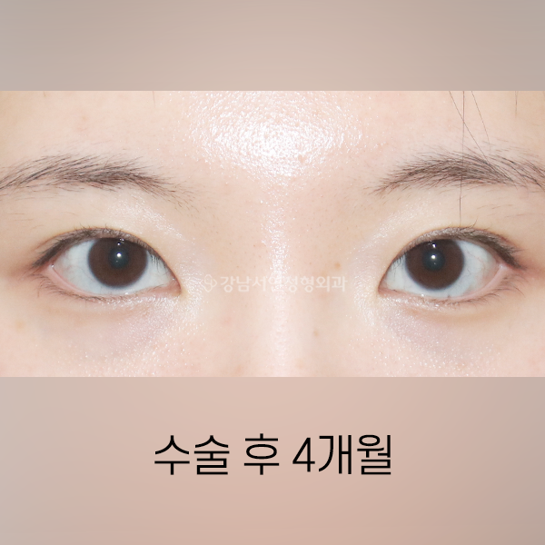 매몰쌍꺼풀 AFTER