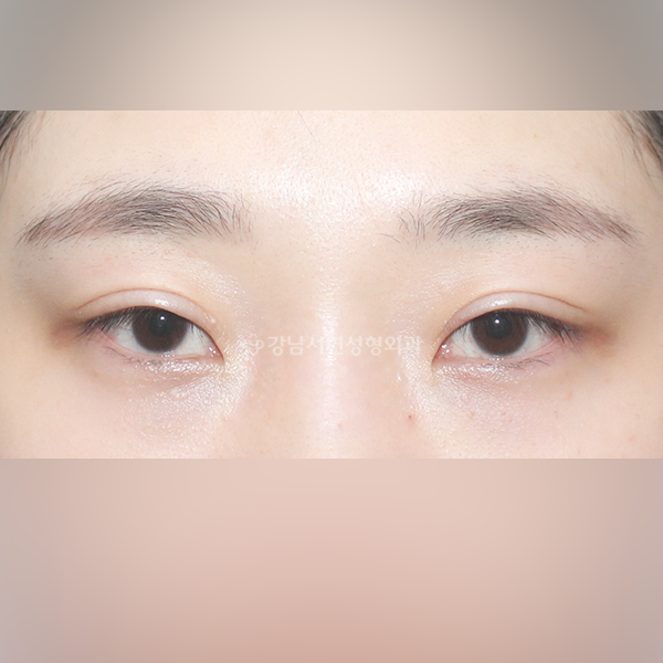 두줄따기 라인낮추기 BEFORE