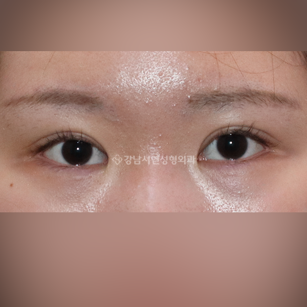 두줄따기 비대칭 맞추기 AFTER