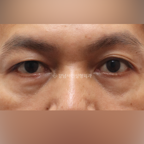 눈밑지방재배치 BEFORE
