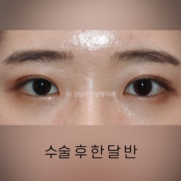 상안검 AFTER