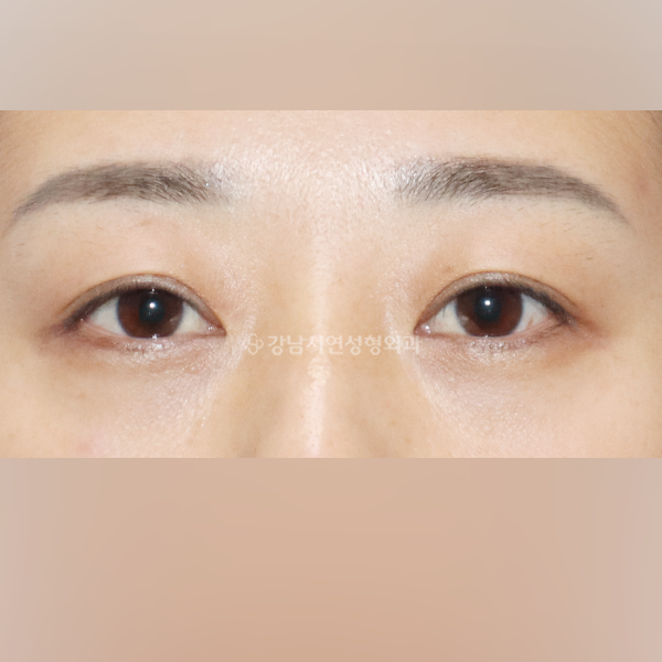 상안검 BEFORE
