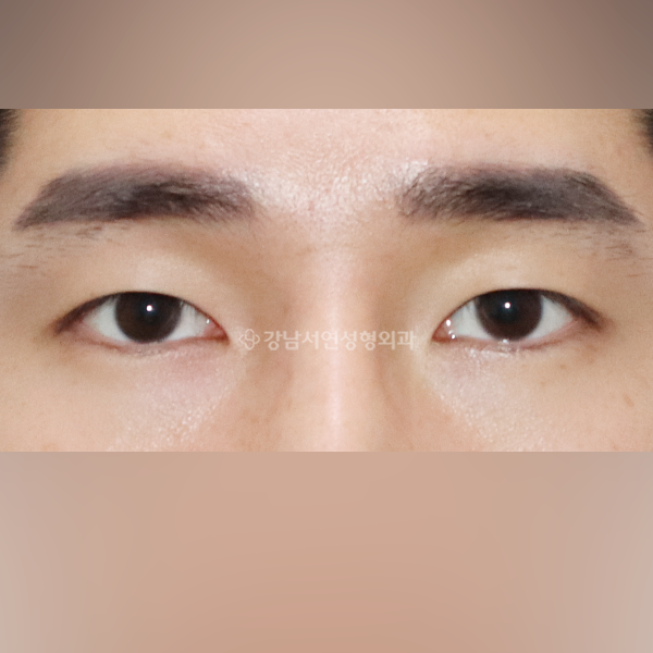 절개눈매교정 AFTER