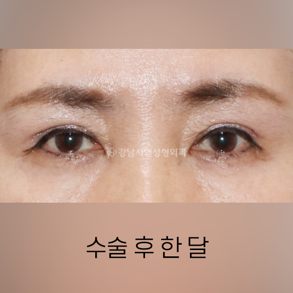 꺼진눈 쌍꺼풀 수술 + 지방이식 AFTER