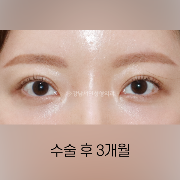 두줄따기 라인낮추기 AFTER