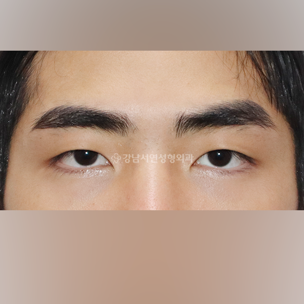 남자 눈매교정 BEFORE