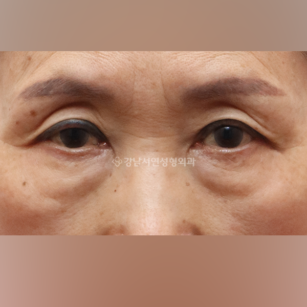 상안검 + 하안검 BEFORE