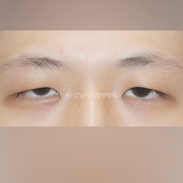 절개눈매교정 + 앞트임 BEFORE