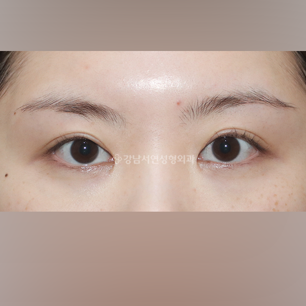 쌍꺼풀 재수술 BEFORE