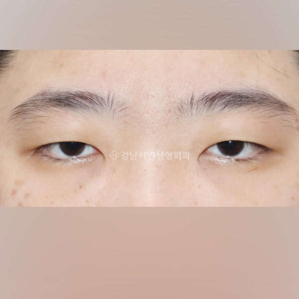 절개쌍꺼풀 + 앞트임 BEFORE