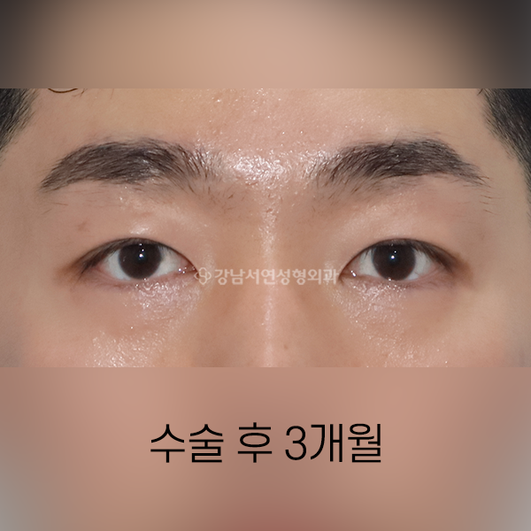 남자 가성안검하수 AFTER