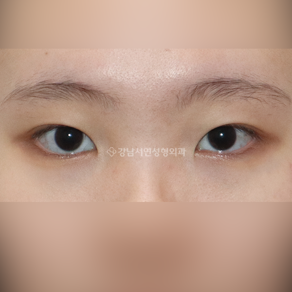 상안검 + 앞트임 BEFORE