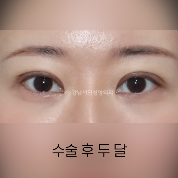 두줄따기 + 점막들림 해결 AFTER