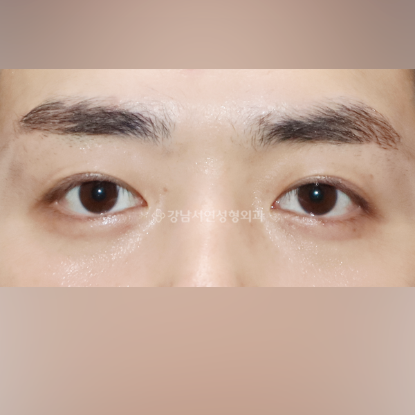 쌍꺼풀 라인낮추기 AFTER