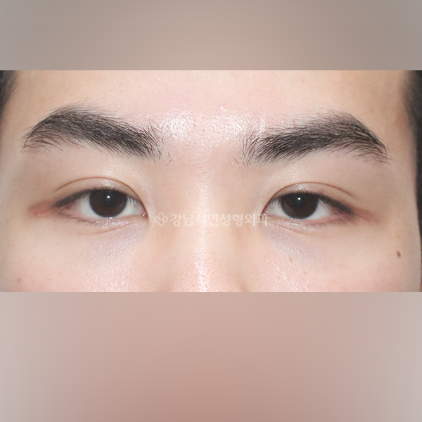 라인낮추기 BEFORE