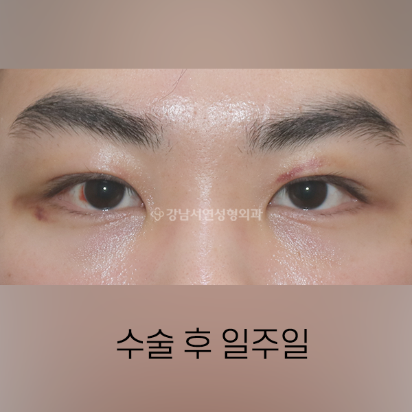 라인낮추기 AFTER