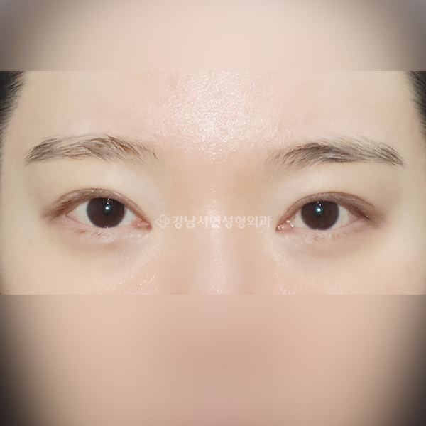두줄따기 AFTER