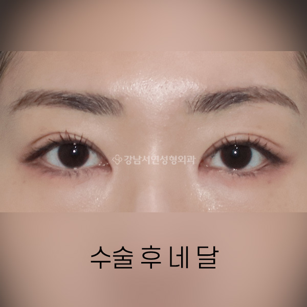 절개쌍꺼풀 + 앞트임 AFTER