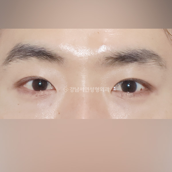 쌍꺼풀 라인 낮추기 1년 경과 AFTER
