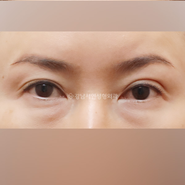 두줄따기 BEFORE