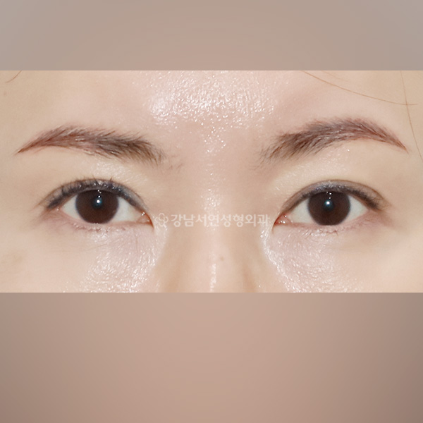 두줄따기 AFTER
