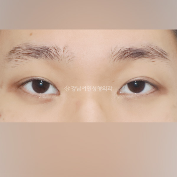 남자 두줄따기 속쌍꺼풀 낮추기 BEFORE