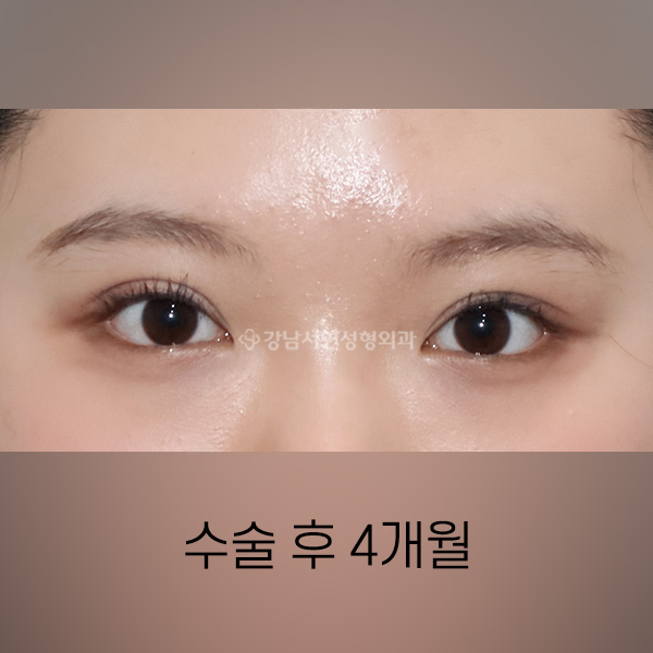 세미아웃라인 절개쌍꺼풀 AFTER