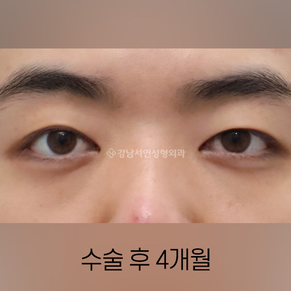 눈밑지방재배치 AFTER