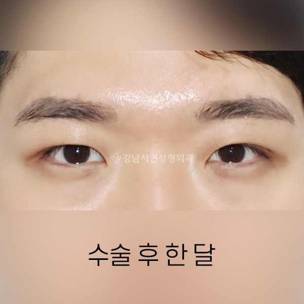 절개쌍꺼풀 AFTER
