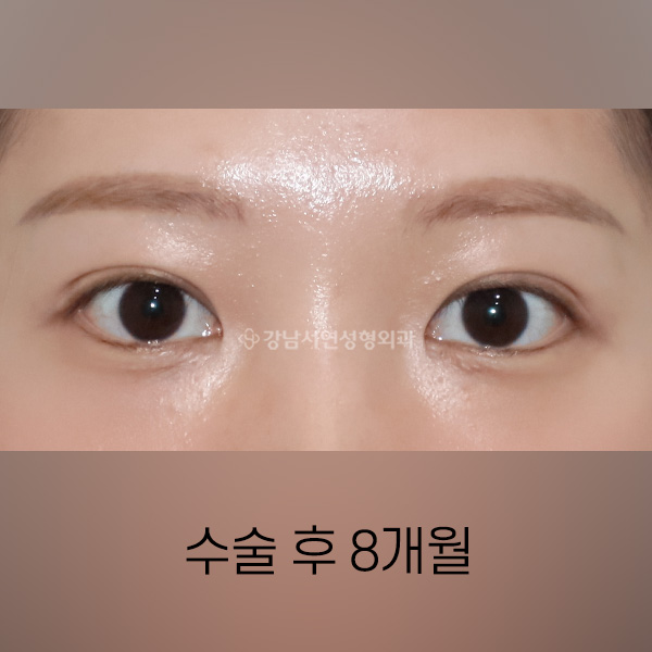 매몰 쌍꺼풀 재수술 AFTER