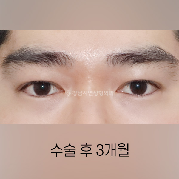 남자 쌍꺼풀 낮추기 AFTER