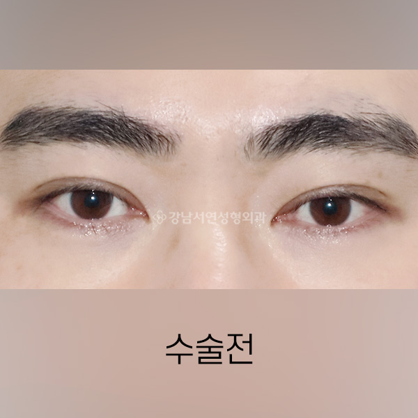 남자 쌍꺼풀 낮추기 BEFORE