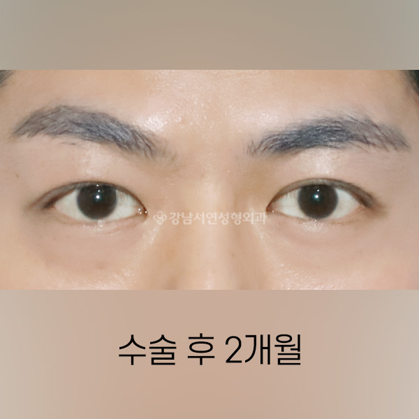 남자 쌍꺼풀 낮추기 AFTER