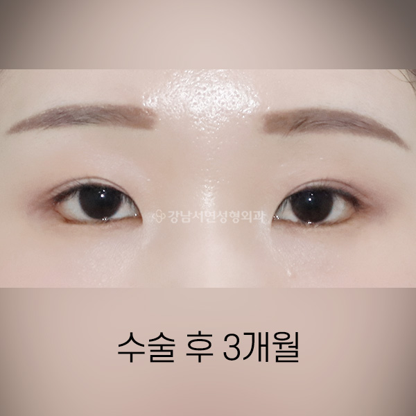 뒤밑트임 AFTER