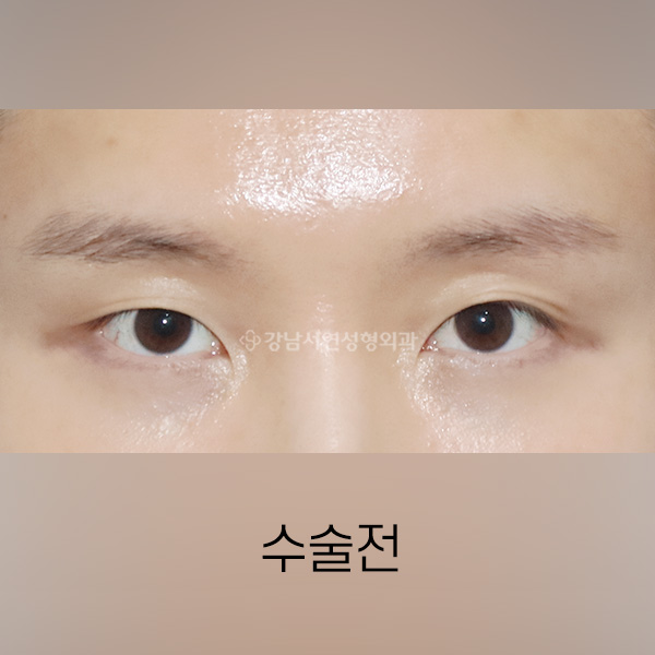 자연쌍꺼풀 라인 낮추기(라인정리) BEFORE