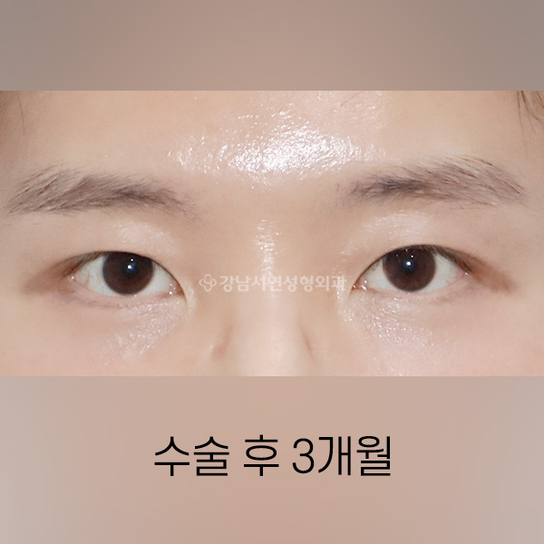 자연쌍꺼풀 라인 낮추기(라인정리) AFTER