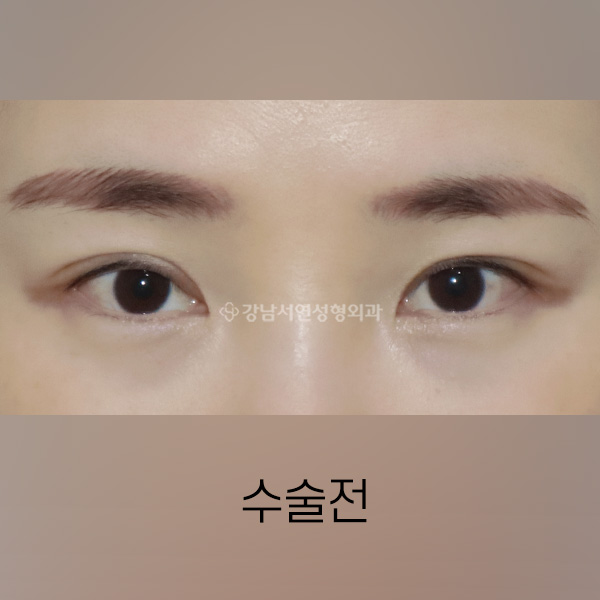 뒤밑트임 BEFORE