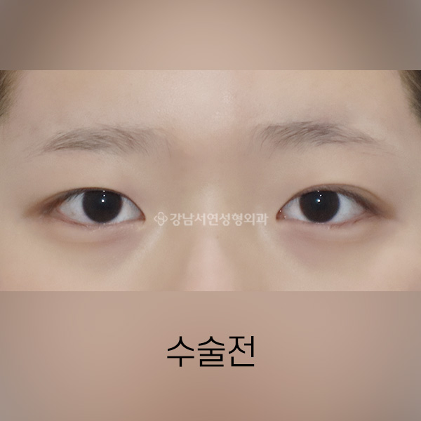 인라인 쌍꺼풀 BEFORE