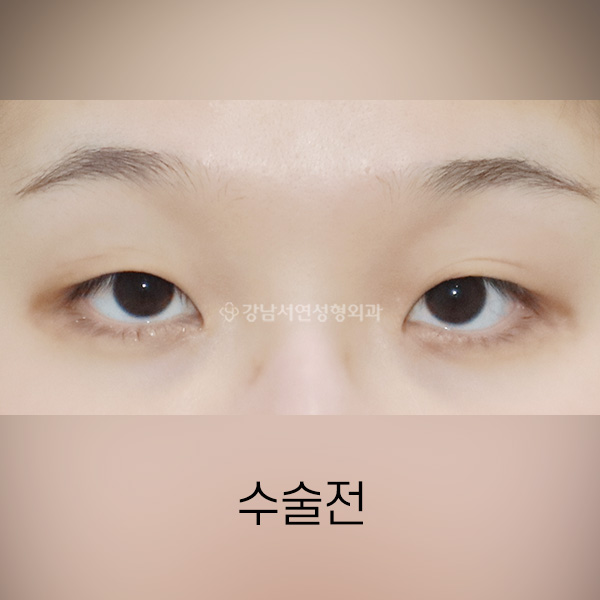 절개눈매교정 + 앞트임 BEFORE