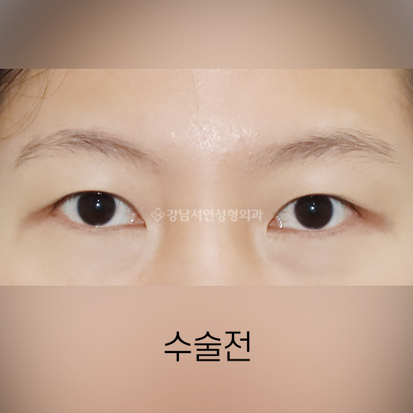 쌍꺼풀 재수술 BEFORE