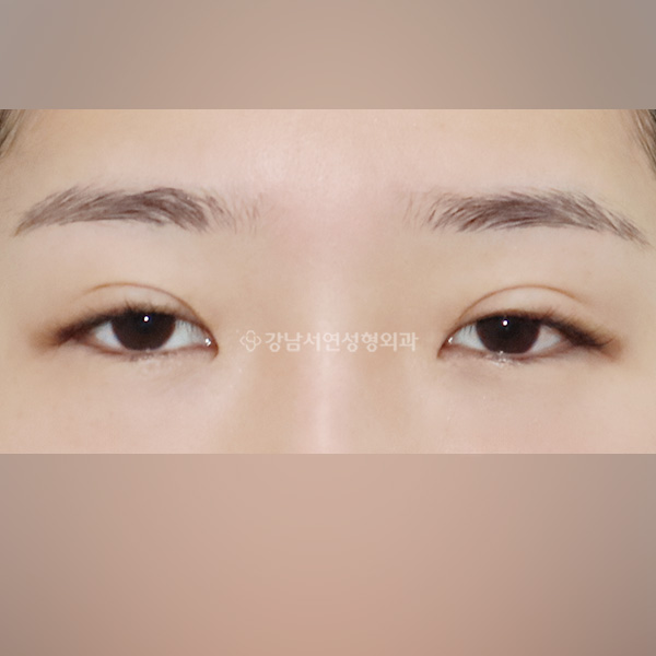두줄따기 + 눈매교정 BEFORE