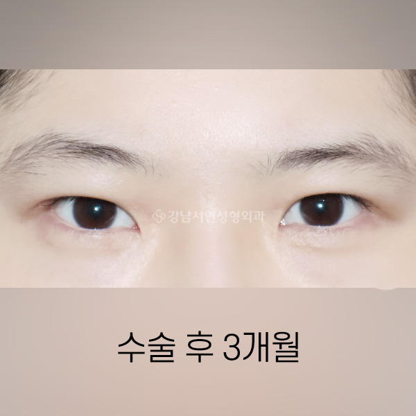 남자무쌍눈매교정 AFTER