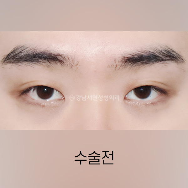 남자 라인낮추기 BEFORE